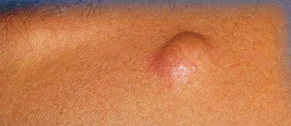 Твёрдые шишки под кожей: причины, фото, какие заболевания, симптомы, нужно ли обращаться к врачу, может ли быть рак