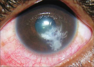 Кератит: симптомы и лечение, глаза, акантамебный, грибковый