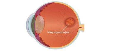 Народные средства лечения при дистрофии макулы глаза