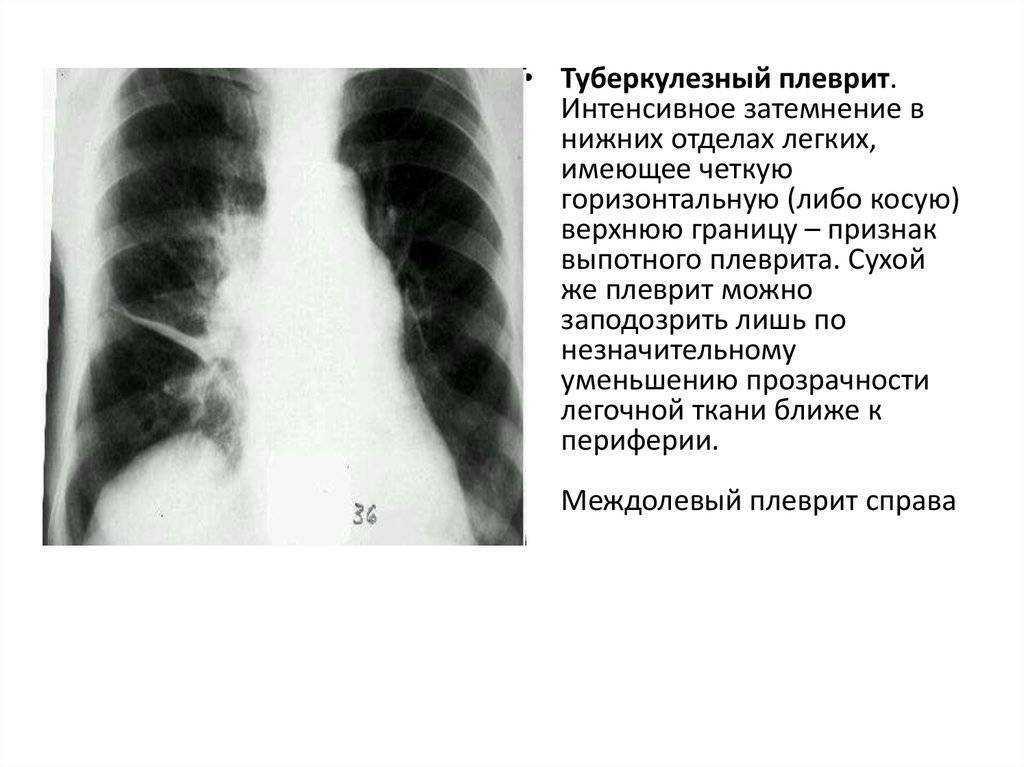 Рентгенологическая картина пневмонии у детей