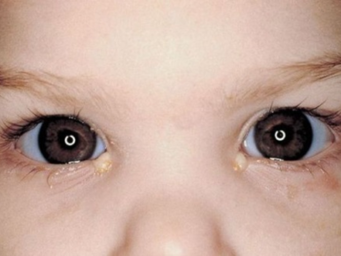 Детские капли для глаз от воспаления и слезотечения