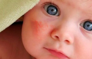 Шелушение кожи у новорожденных