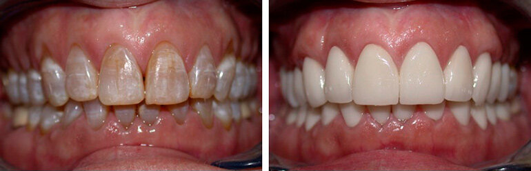 Как восстановить зубы и причина разрушения зубов