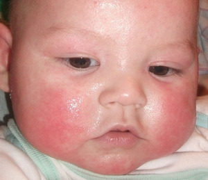 Лечение себорейного дерматита в детском возрасте