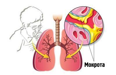 Стадии крупозной пневмонии: как развивается заболевание