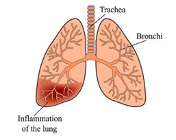 Прикорневая пневмония