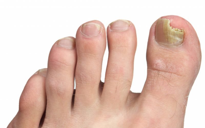 Грибок ногтей на ногах: лучшее средство для лечения,таблетки,эффективные лекарства, отзывы