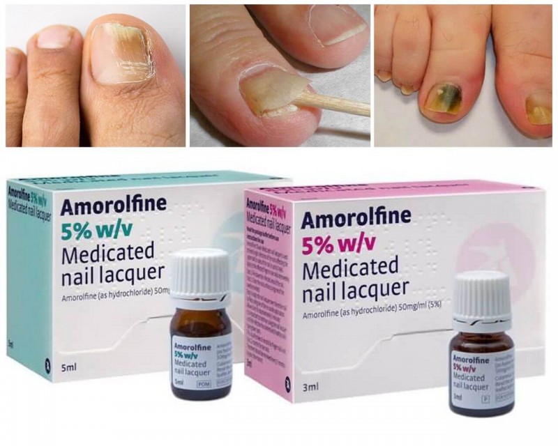Аморолфин для лечения грибка ногтей