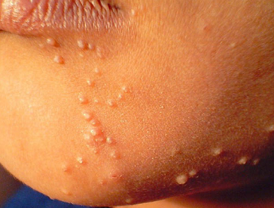 Виды контагиозного моллюска у детей. симптомы и лечение