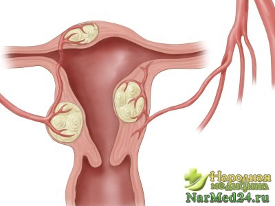 Аденомиоз матки 1 степени: причины, симптомы, лечение