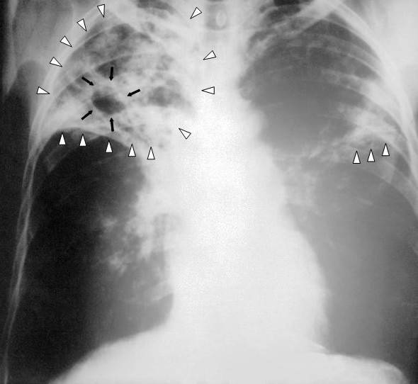 Туберкулез легких: признаки ранней стадии, симптомы и лечение у взрослых