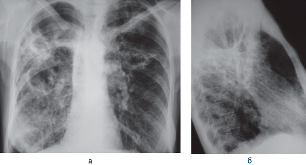 Туберкулез на рентгене
