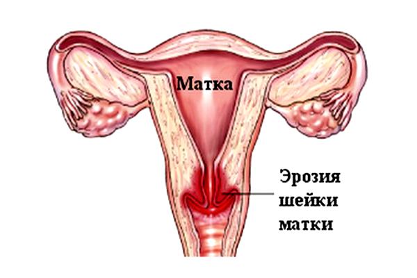 Симптомы и лечение дисплазии шейки матки в зависимости от степени онкологии