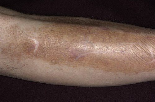 Нарушения пигментации кожи (витилиго, альбинизм, мелазма): причины, симптомы, диагностика, лечение