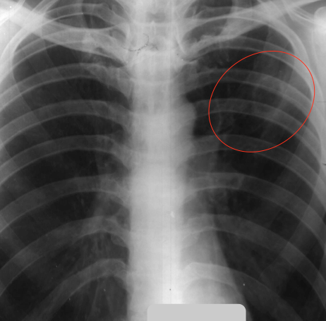 Как выглядит туберкулез легких на снимке рентгена