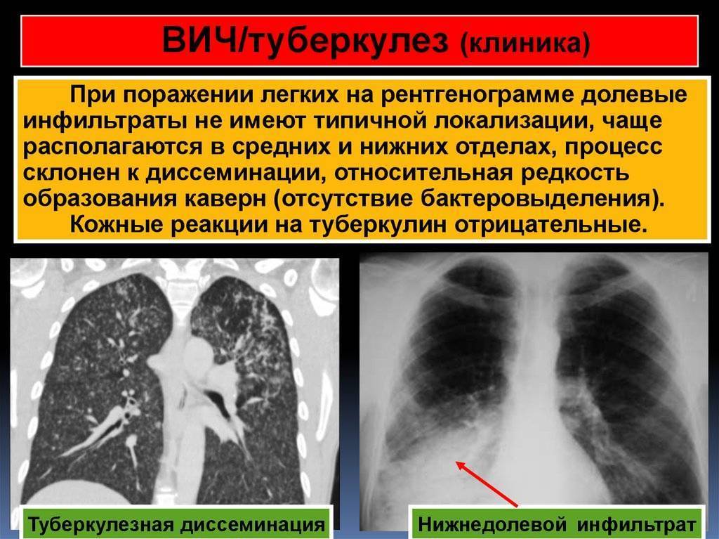 При туберкулезе чаще поражаются. Диссеминация туберкулеза на рентгене. Диссеминированный туберкулез на кт. Туберкулез поражение легких.