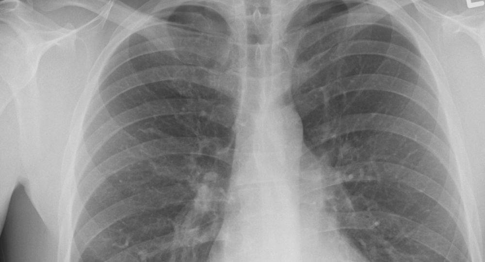 Открытая форма туберкулеза – что это, опасно ли для окружающих и кто входит в группу риска