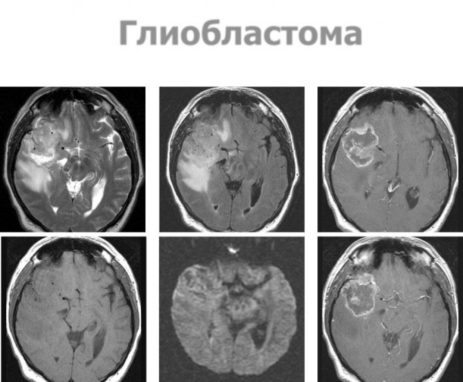 Глиобластома головного фото