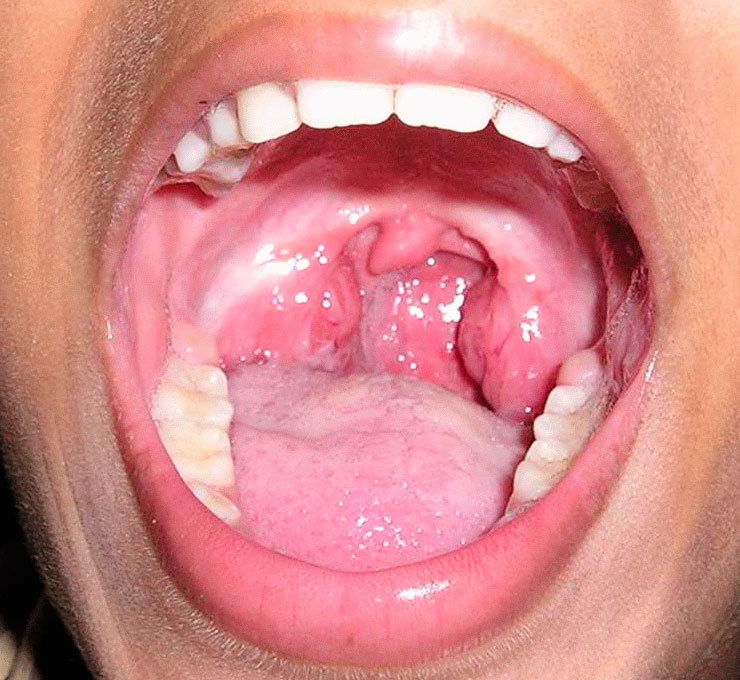 Паратонзиллит и паратонзиллярный абсцесс в горле: симптомы и лечение + фото