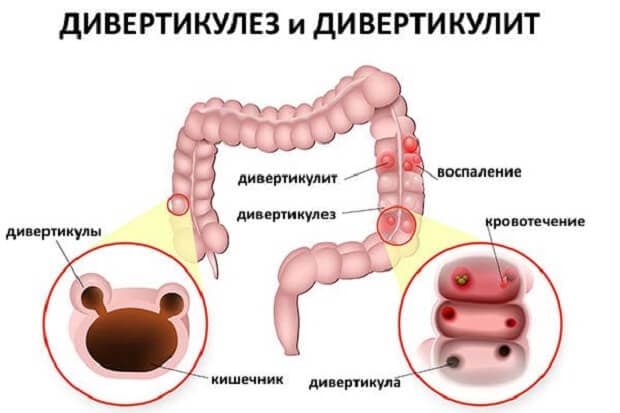 Дивертикулез толстого кишечника - симптомы и лечение, диета, осложнения | здрав-лаб