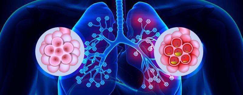 Бронхит и пневмония: отличия и сходство заболеваний