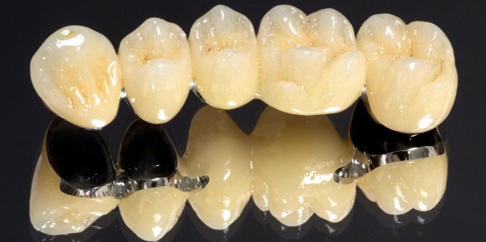 Мостовидный протез на имплантах: надежность фиксации и защита зубов