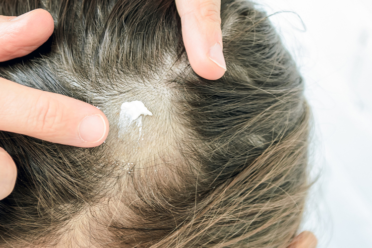 Грибковые заболевания кожи головы и лица: симптомы и лечение