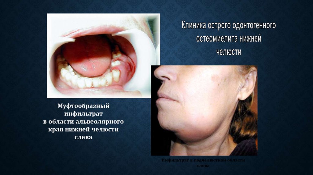 Остеомиелит челюсти: симптомы, диагностика, лечение
