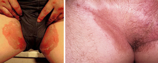 Паховая эпидермофития у мужчин и женщин: фото, симптомы и лечение грибка в паху