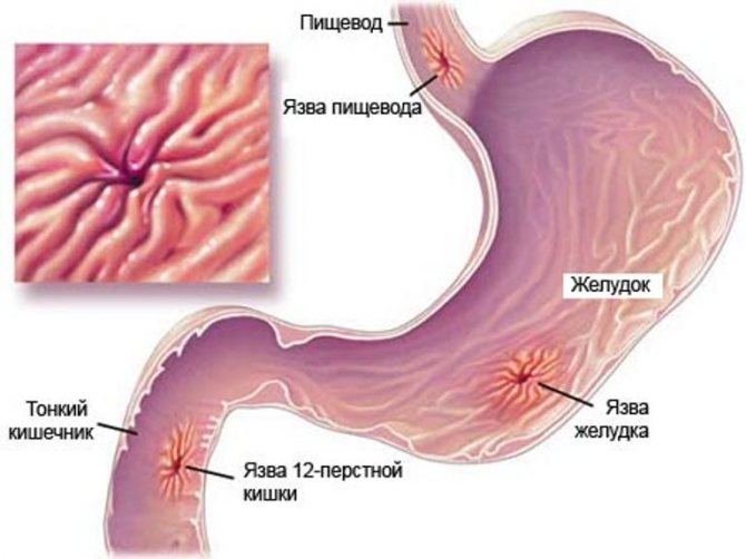 Питание после операции язвы желудка прободной язвы