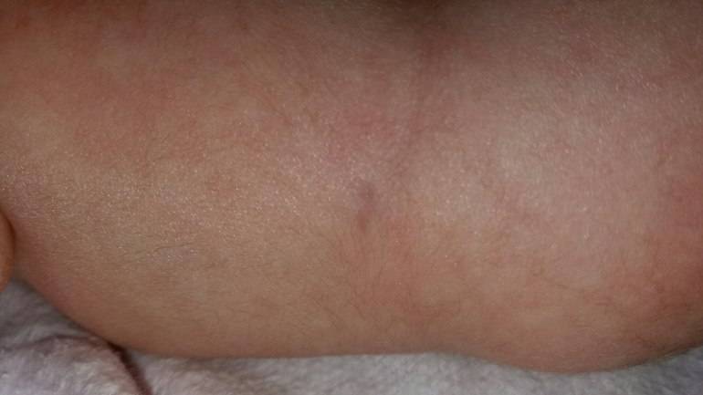 Вакцина бцж грудничку: что это такое? надо ли прививать малыша в роддоме? возможные реакции организма ребенка