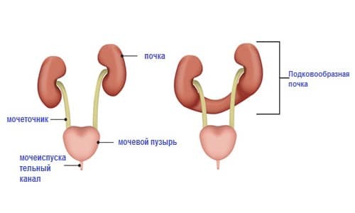 Подковообразная почка у ребенка чем опасна