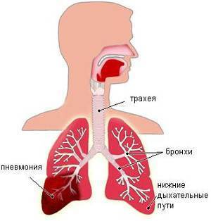Как распознать пневмонию без температуры и кашля симптомы