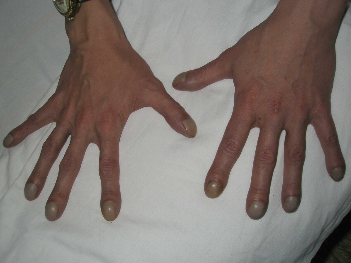 Как определить болезни по ногтям на руках и ногах