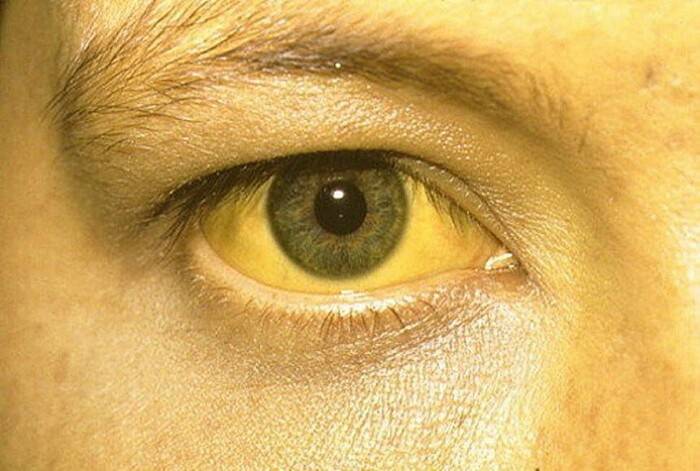 Желтые белки глаз: причины, лечение