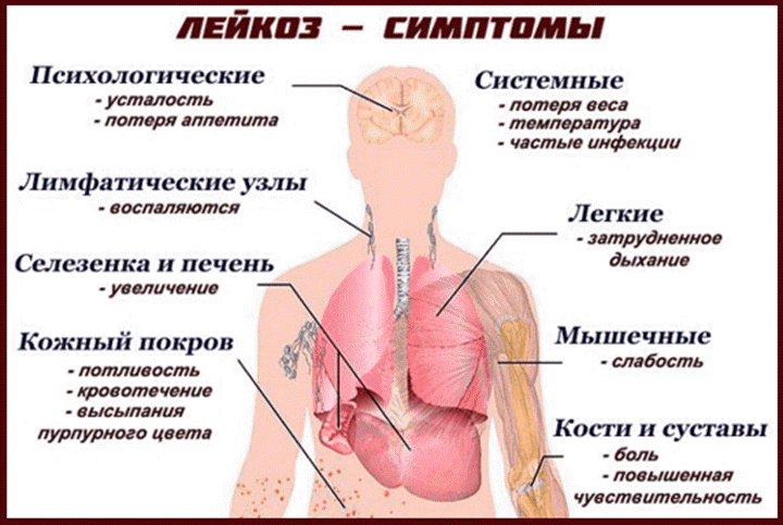 Лейкоз крови симптомы у взрослых анализ крови | 1analiz.ru