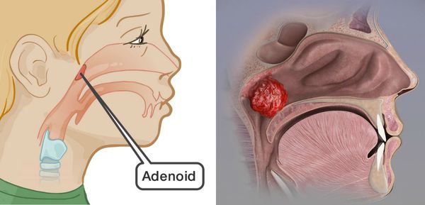 Аденоидит симптомы и лечение у детей