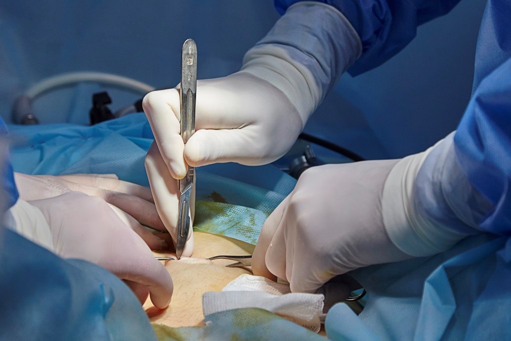 Операция лапароскопия: как проводится, область применения и этапы