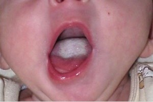 Болезни языка у человека: фото, симптомы, чем лечить, к какому врачу обращаться
