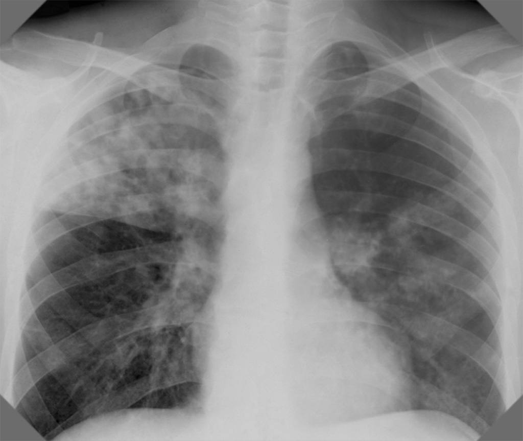 Флюорография: туберкулёз на рентгеновском снимке