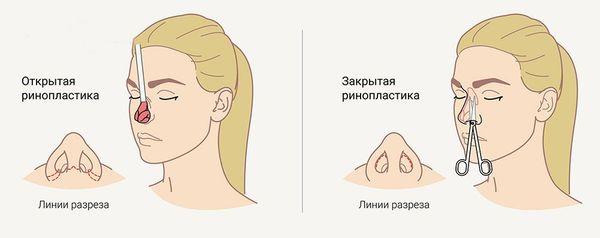 Коррекция формы и функции носа (риносептопластика)