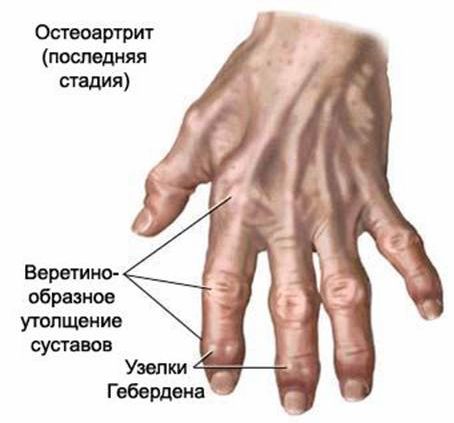 Причины, симптомы и лечение артрита пальцев рук