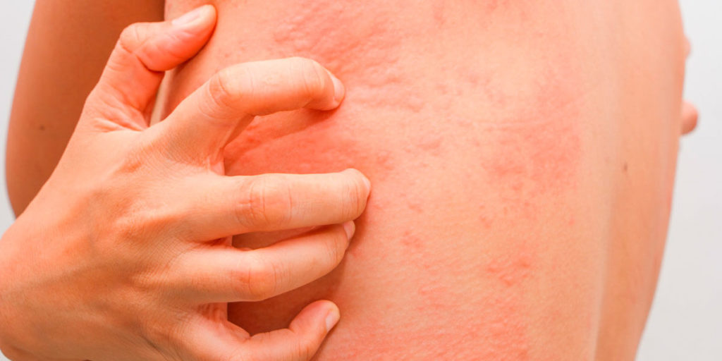 Инфекционно-аллергическая болезнь у детей и взрослых