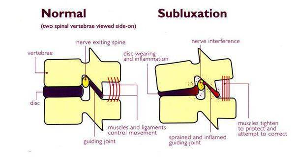 Подвывих шейного позвонка у ребенка или взрослого: лечение и симптомы, причины ротационного вывиха