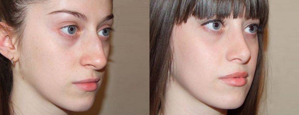 Пластика крыльев носа фото до и после