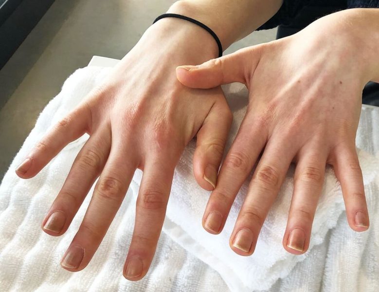 Симптомы и лечение грибка ногтей на руках (онихомикоза)
