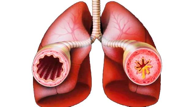 Особенности симптомов бронхиальной астмы и отличия от других заболеваний