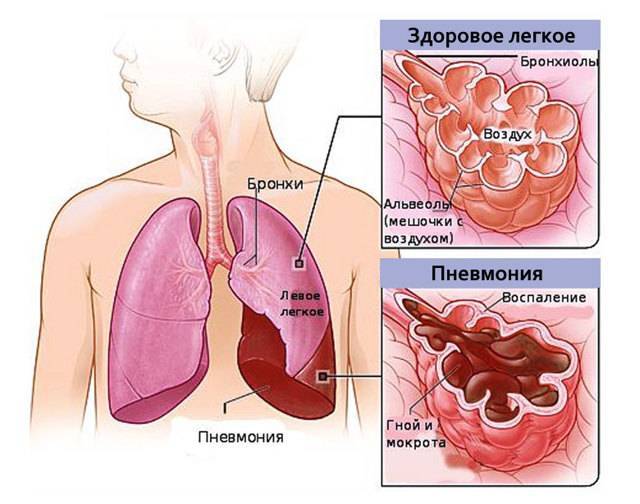 Методика восстановления легких дыхательной гимнастикой после пневмонии