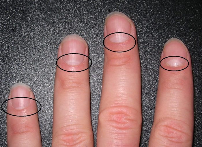 Определение заболевания по ногтям на руках фото