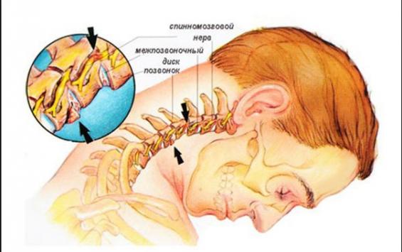 Как лечить шейный остеохондроз? остеохондроз шейного отдела позвоночника – лечение, упражнения